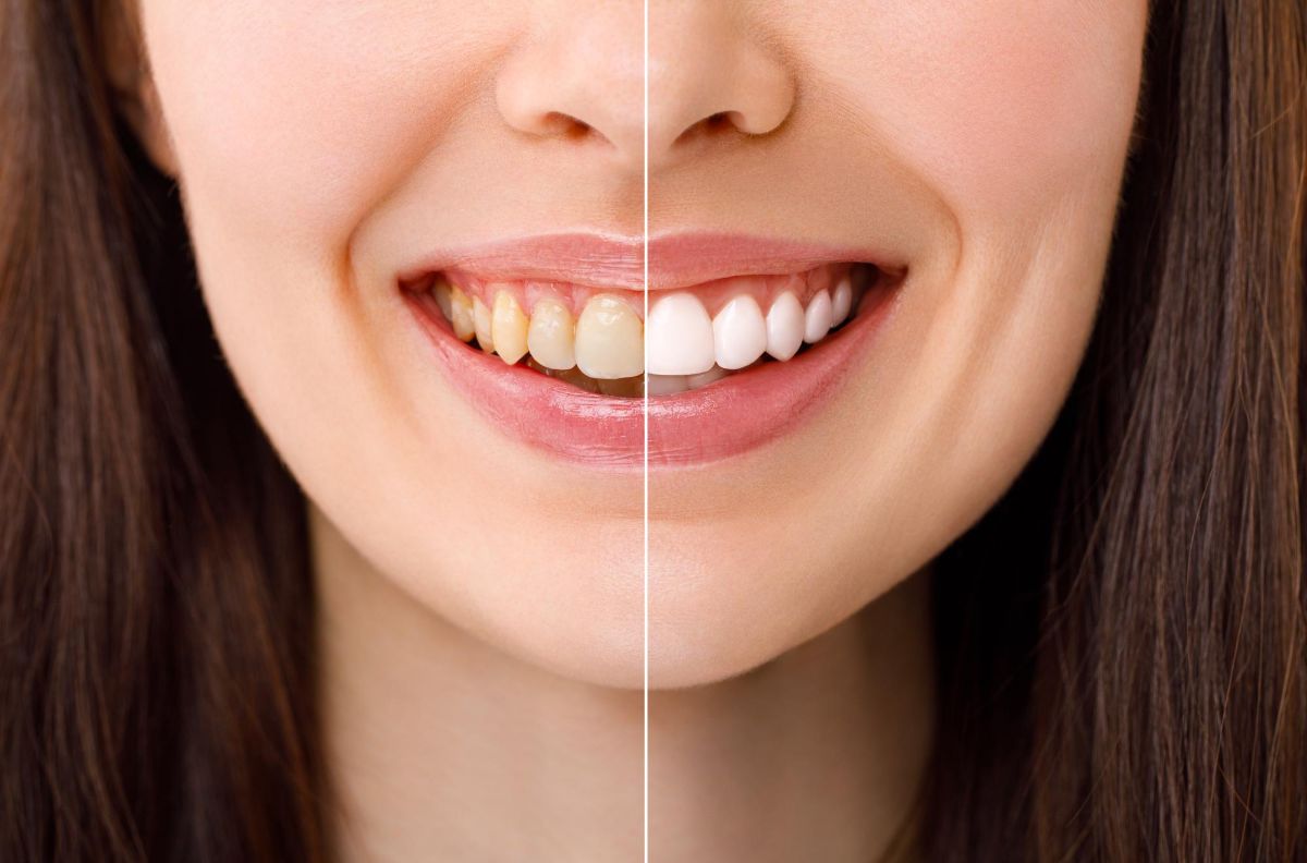 wybielanie zębów efekty caban stomatologia